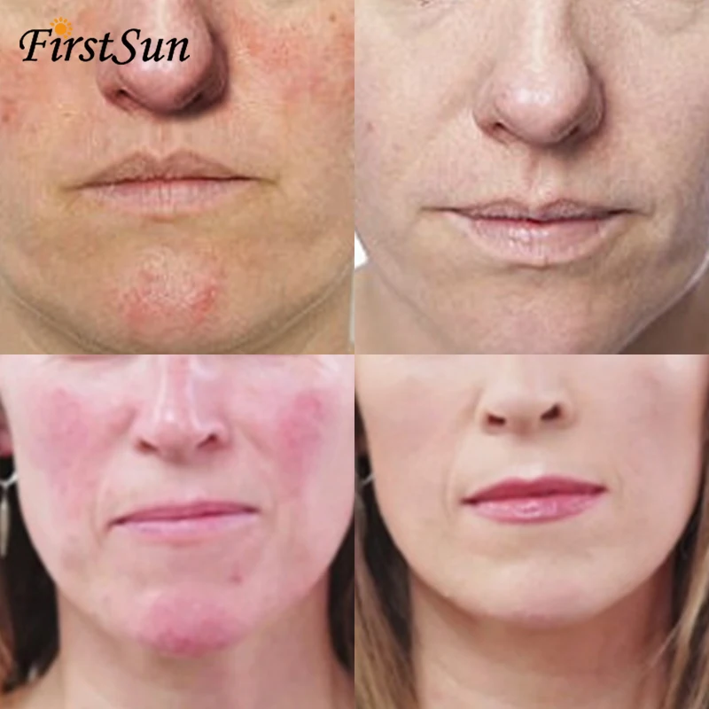 Травяные анти носовые клещи удаляют розовые угри крем для удаления черных точек