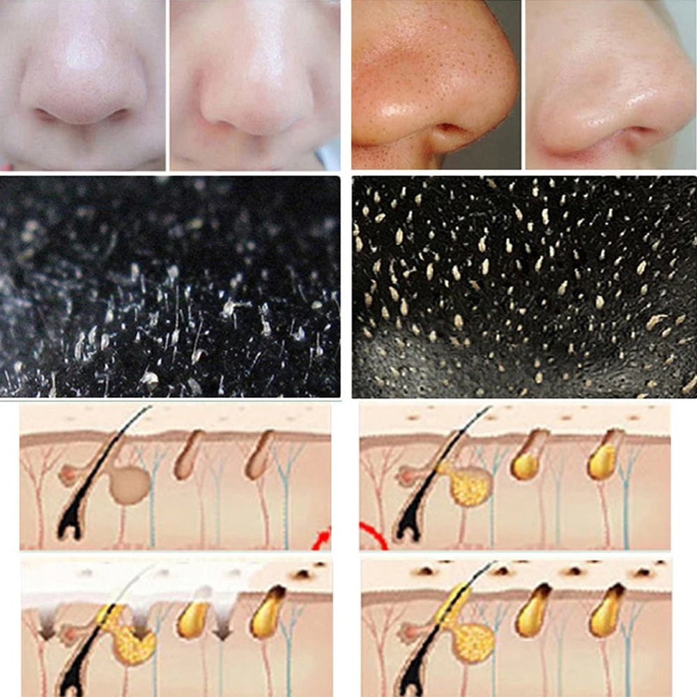 Effective Blackheads Removal Mask Nose Purifying Deep Cleaning 10pcs Black Pore Contraction T District Care Water Hydrating | Красота и