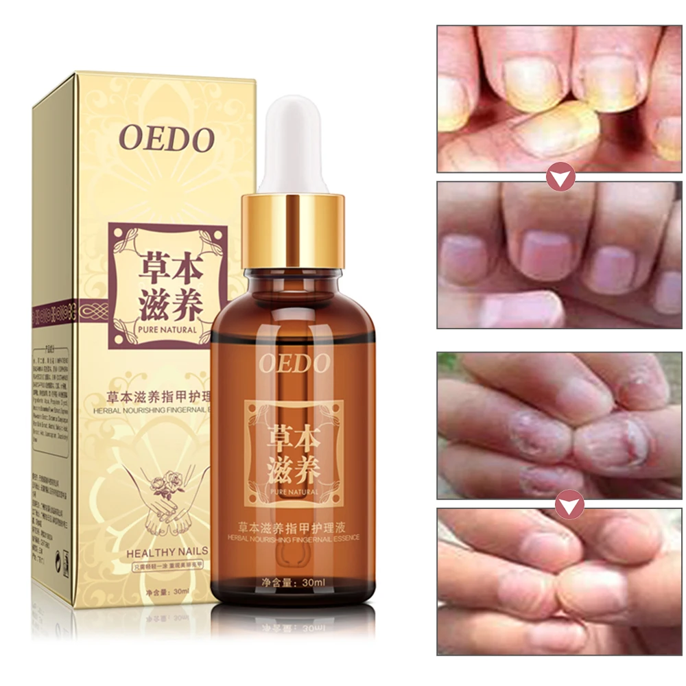 

Fungal Nail Treatment Serum Onychomycosis Paronychia Anti-Fungal Nail Infection Herbal Toe Fungus Foot Repair Essence Care 30ml