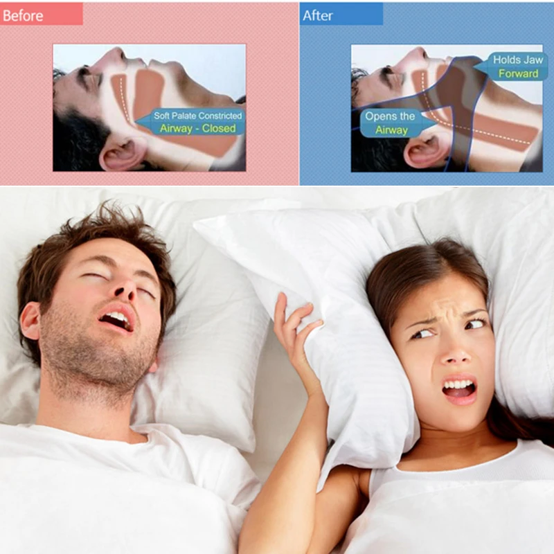 Силиконовый мини ремень для предотвращения храпа останавливающий дыхательный