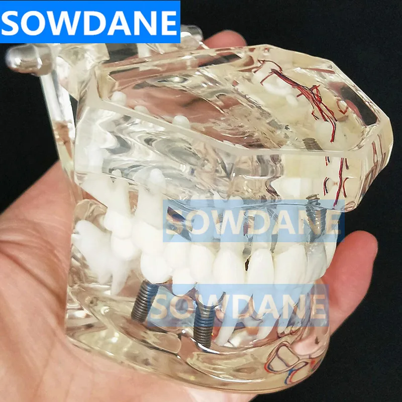 Модель зубного имплантата с мостиком для восстановления зубов стоматолог