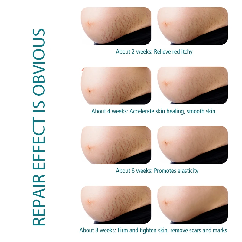 

Natural Pregnancy Stretch Marks Remover Cream Acne Scar Removal Cream Skin Repair Anti Winkles Anti-Aging Firming Body Cream