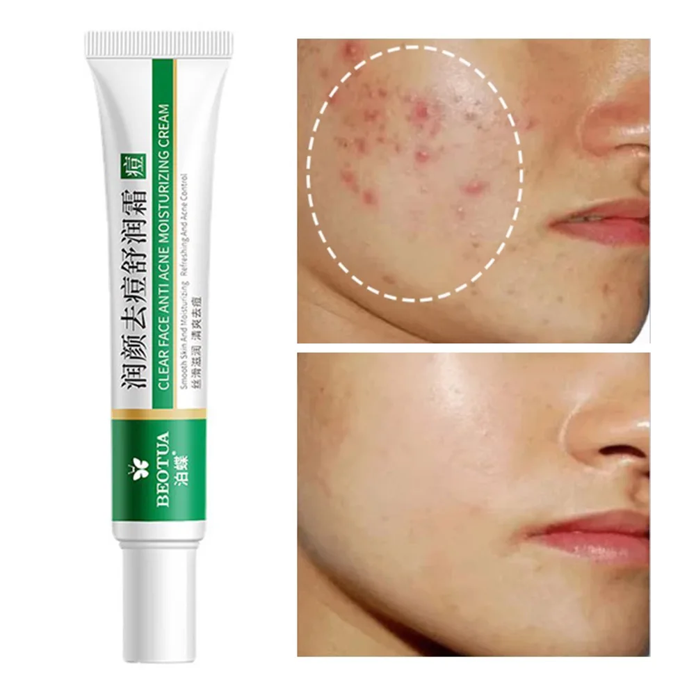 

Эффективное средство для удаления прыщей, средство для восстановления кожи от прыщей, отбеливающий увлажняющий гель для лица, уход за кожей...