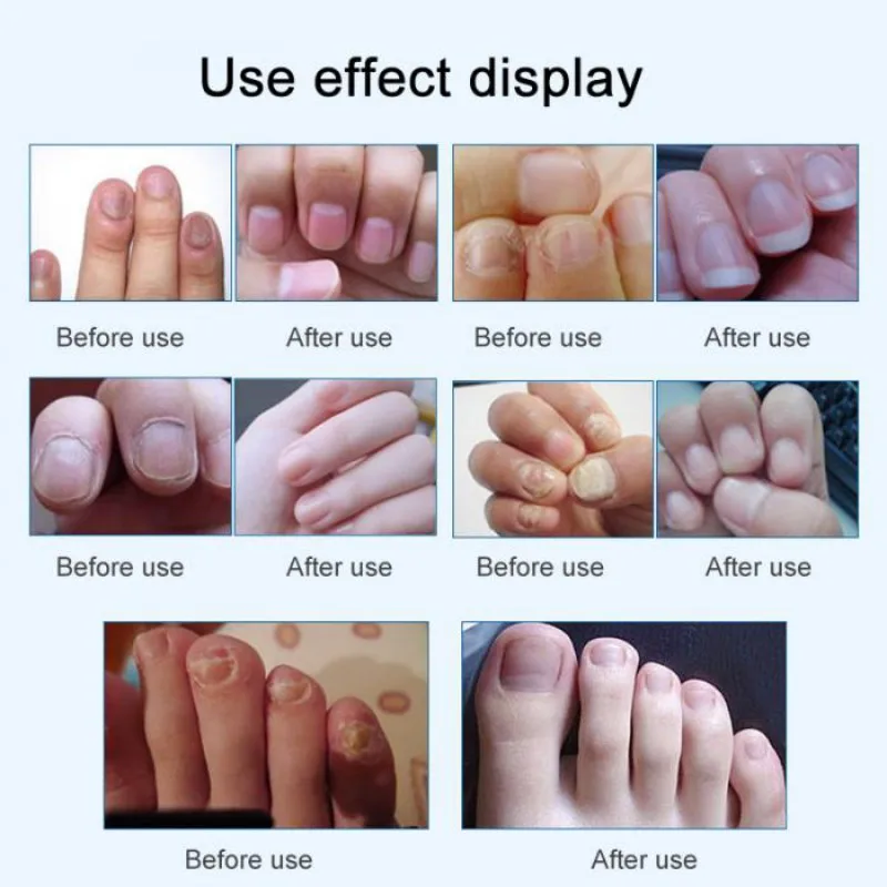 Средство для лечения грибка ногтей удаление онихомикоза восстановление от