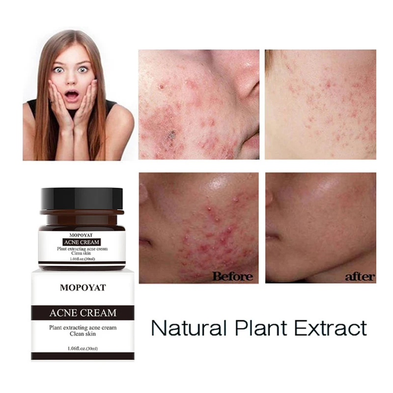 30 г крем от акне лечение угрей сокращение пор ремонт удаления контроль шрамов