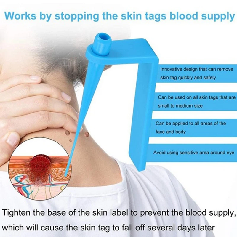 Медицинская Non токсический кожу средство удаления бирок инструмент для взрослых