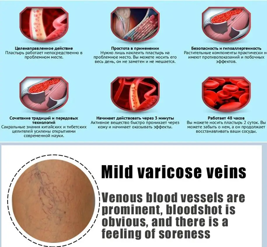 Без коробки! Китайская натуральная травяная медицина для лечения варикозного