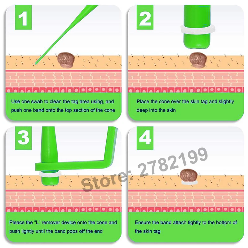 

Groene Versie Huid Tag Remover Kit Micro Bands Wratten Verwijdering Machine Voor Huid Tag Remover Gezicht huidverzorging Salon