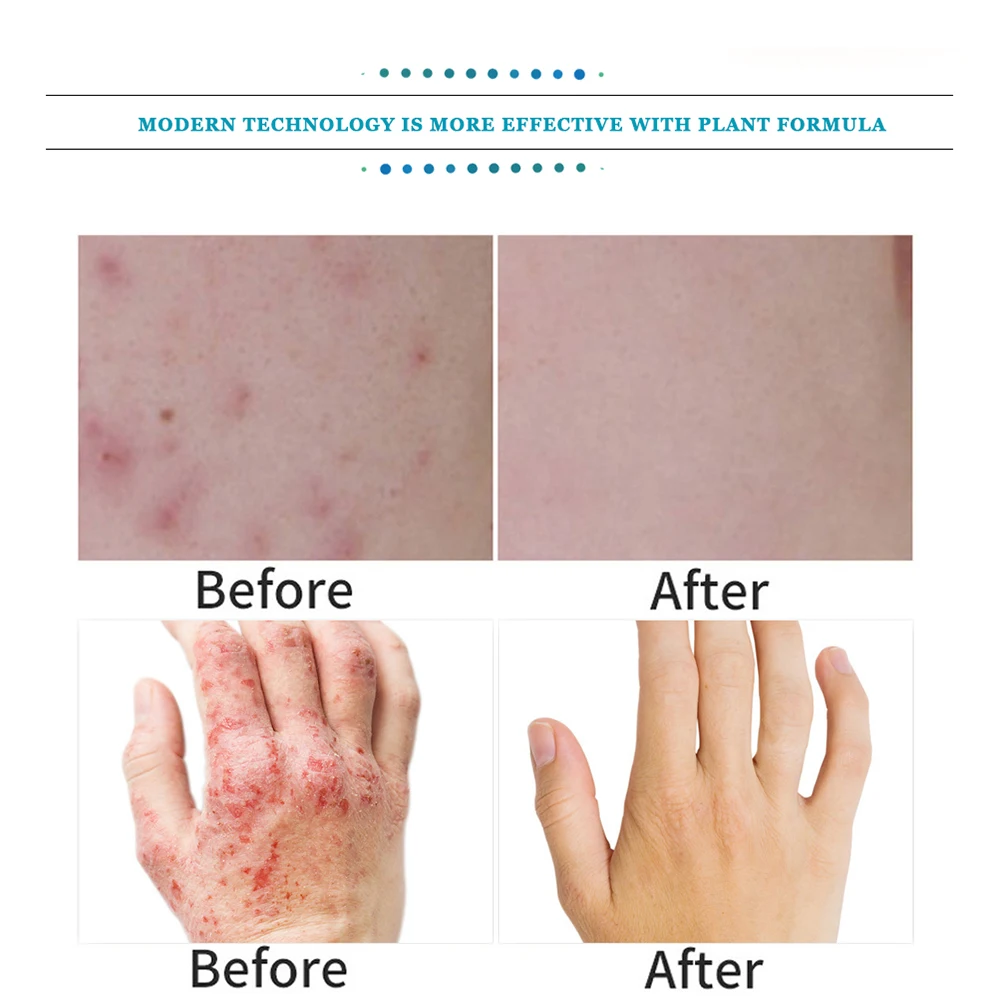 Антибактериальный крем от псориаза Yoxier лечение экземы крапивницы удаления зуда |