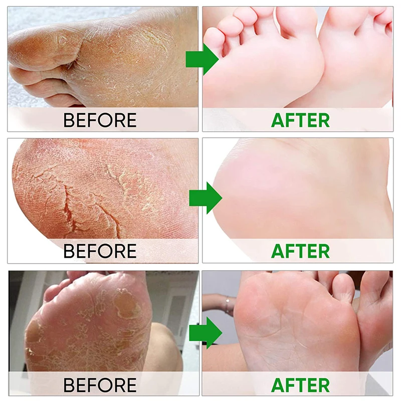 5 упаковок отшелушивающая маска для ног с алоэ|Стопы| |