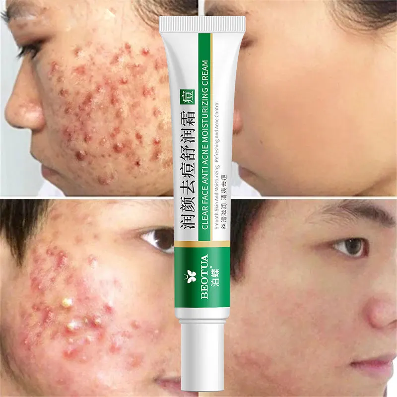 Effective Acne Removal Cream Herbal Acne Spots Oil Control Acne Cream Skin Care Whitening Moisturizing Face Gel Skin Care 20g