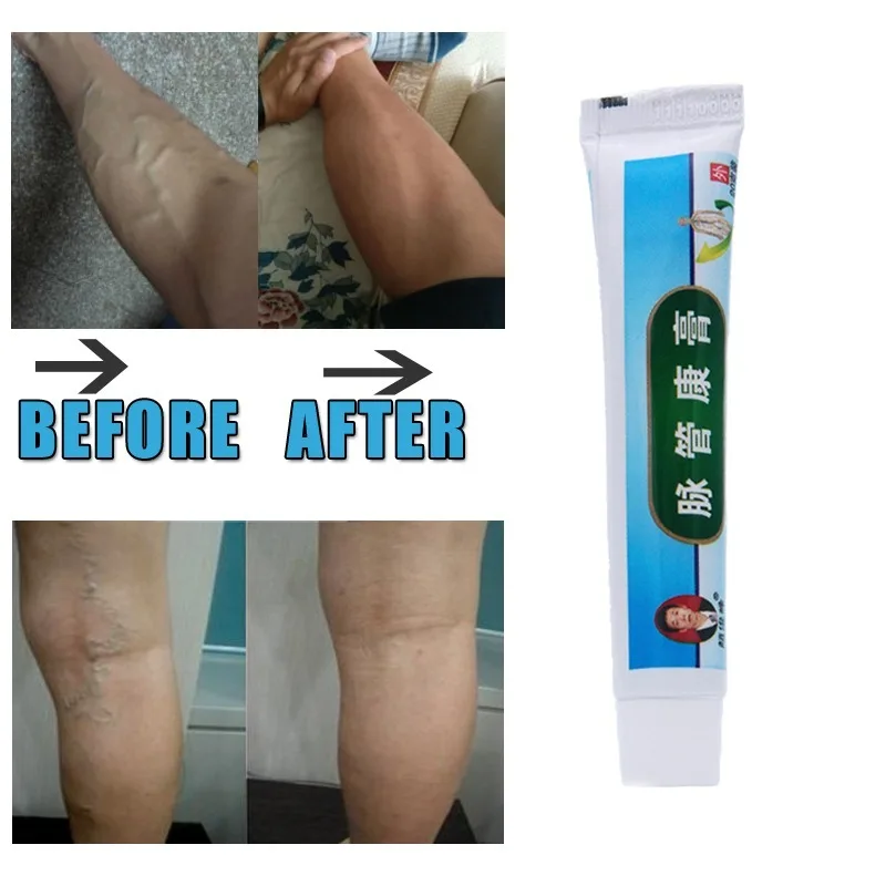 

Ifory Chinese Natural Herbal Medicine for Varicose Veins Ointment Vasculitis Inflammation Leg MassageVaricose Veins Cream