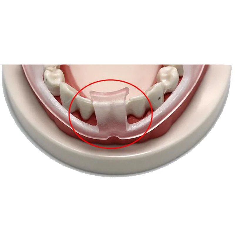 

Anti-Snoring Dental Teeth Guard Prevent Night Teeth Tooth Grinding Sleep Aid Bruxism Splint help to Cultivate Good Heathy Habit
