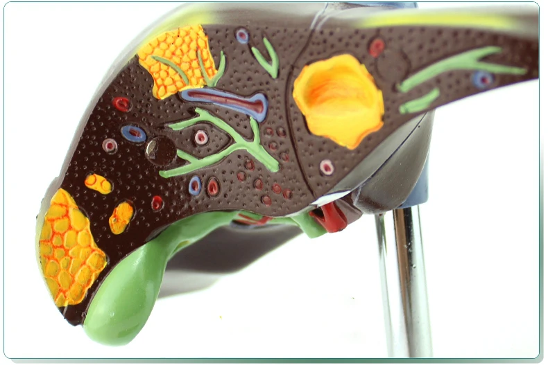 Гепатит В жировая печень цирроз печени модель пищеварительная медицина