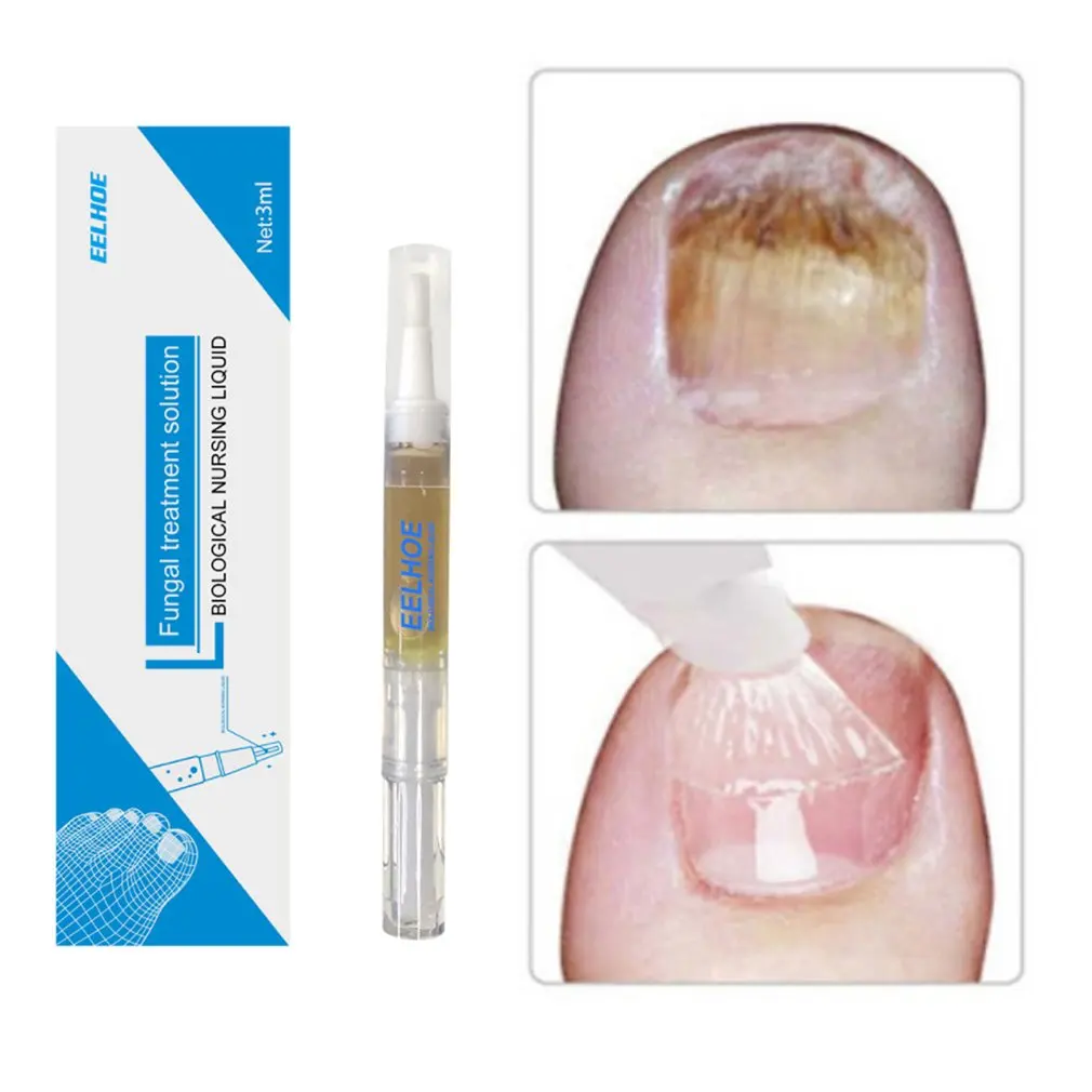 

3 мл ручка для лечения грибковых ногтей онихомикоз паронихия противогрибковая инфекция ногтей китайский травяной Лечение грибка ногтей