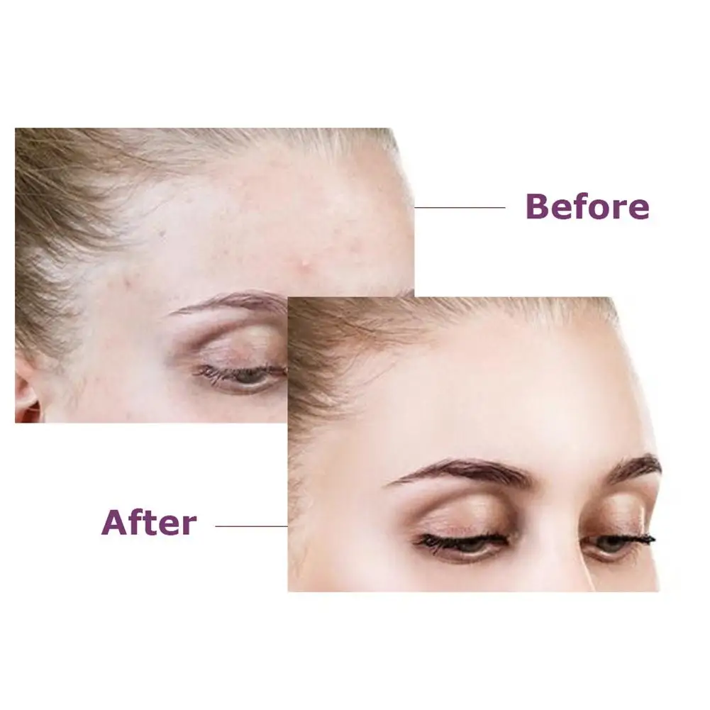 36PCS акне туалетный пятно патч прозрачный гидроколлоидная инструмент для