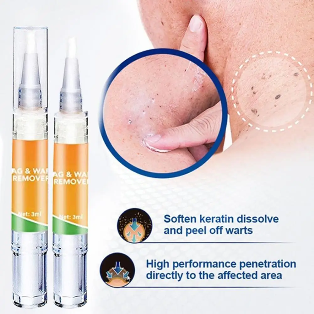 Крем для лечения бородавок устройство удаление Антибактериальная мазь удаления