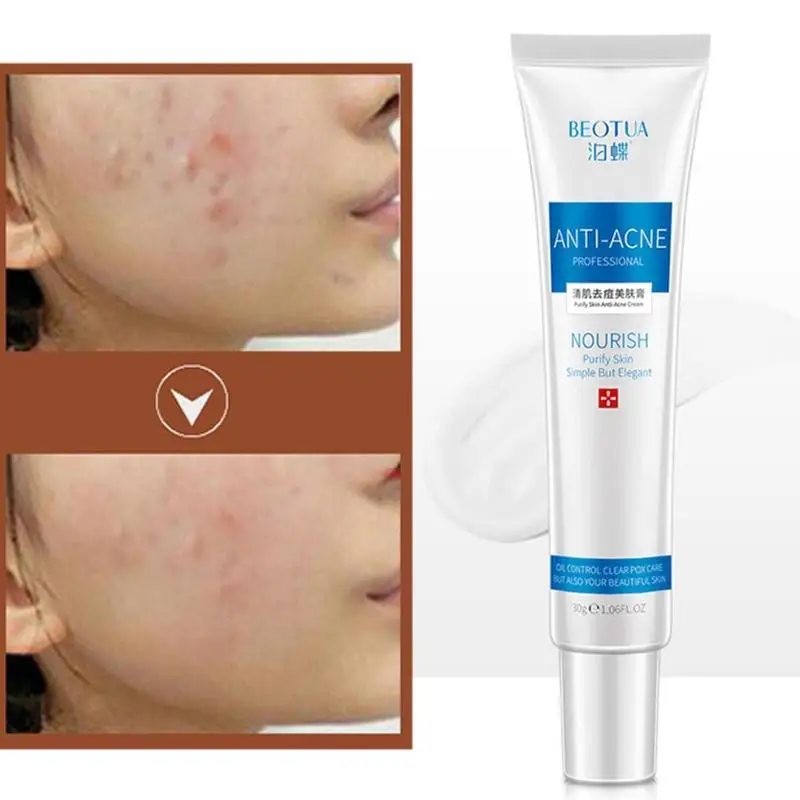 Aloe Acne Face Cream Treatment Anti-acne Scar Day Cream Pores Control Oil Acne Remove Whitening Shrink Care Face Collagen S D3Y5