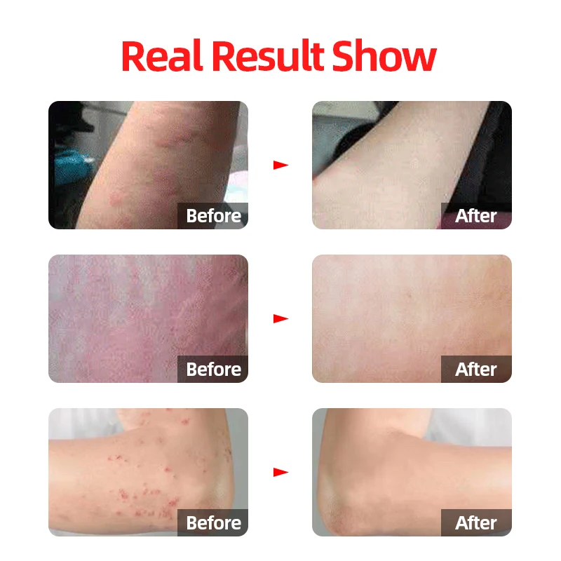 Крем от кори острых и хронических крапивников экземы клещей дерматита | Красота