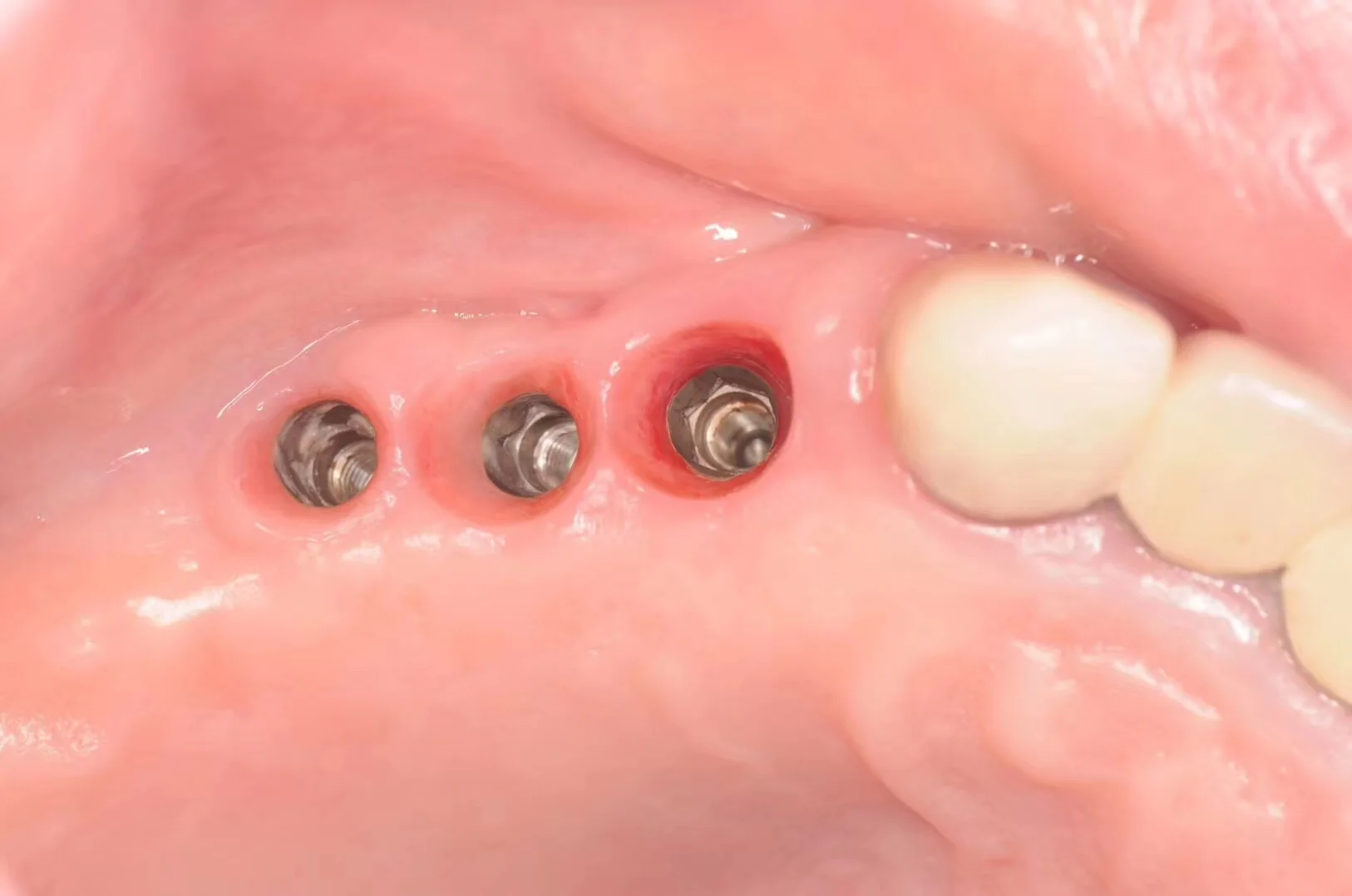 Одобрено CE Корея оригинальный зубной имплантат HN набор для формирования чистых