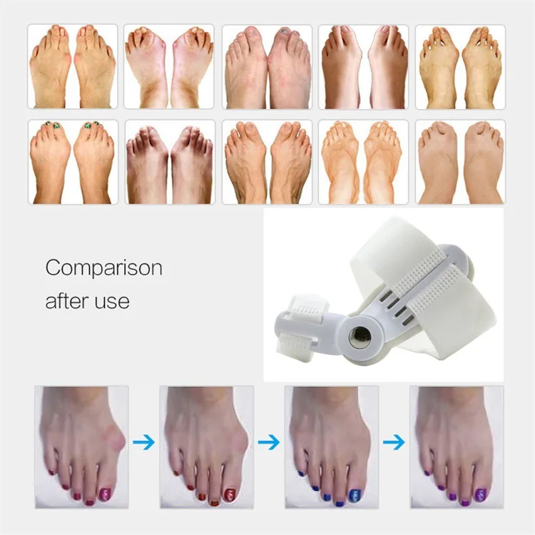 2Pcs Foot care Tool Big Toe Hallux Valgus Orthosis Brace Bunion Splint Straightener Corrector Pain Relief Pedicure | Красота и