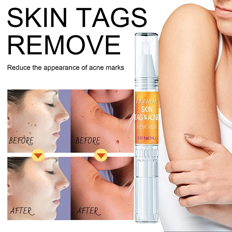 

Skin Tag Mole Wart Remover Liquid WipeOff Tags & Moles Removal Pen Organic