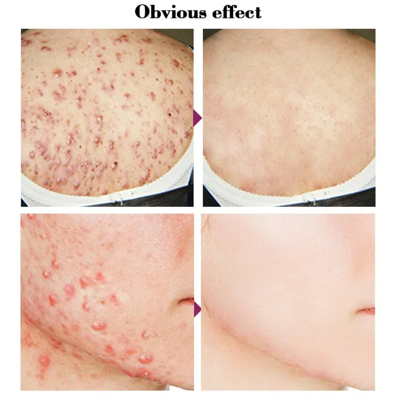 5 пар/10 шт./коробка пластыри для ног | Красота и здоровье