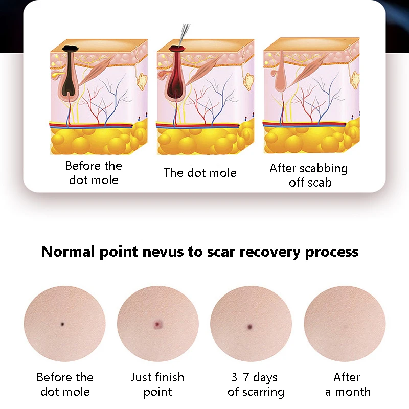 Лазерная плазменная ручка прибор для удаления веснушек родинок татуировок