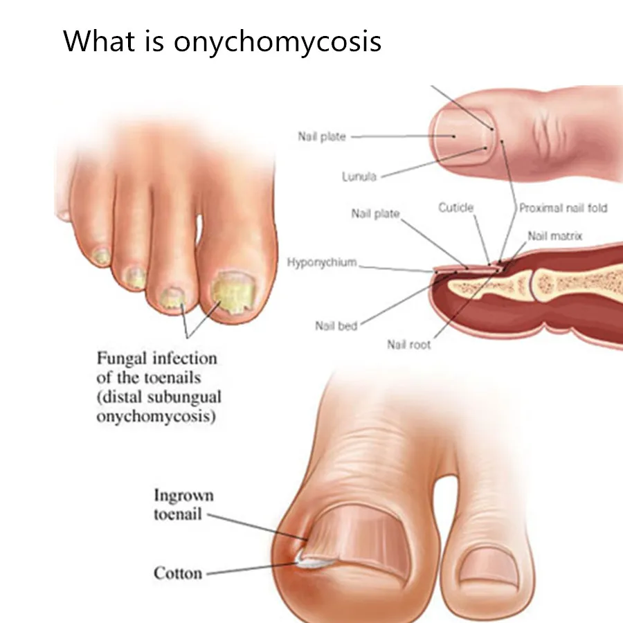 Ноги рук гриб мертвой Уход за ногтями Onychomycosis лечение удалить смягчающее масло стерилизации кутикулы парафин восковой крем