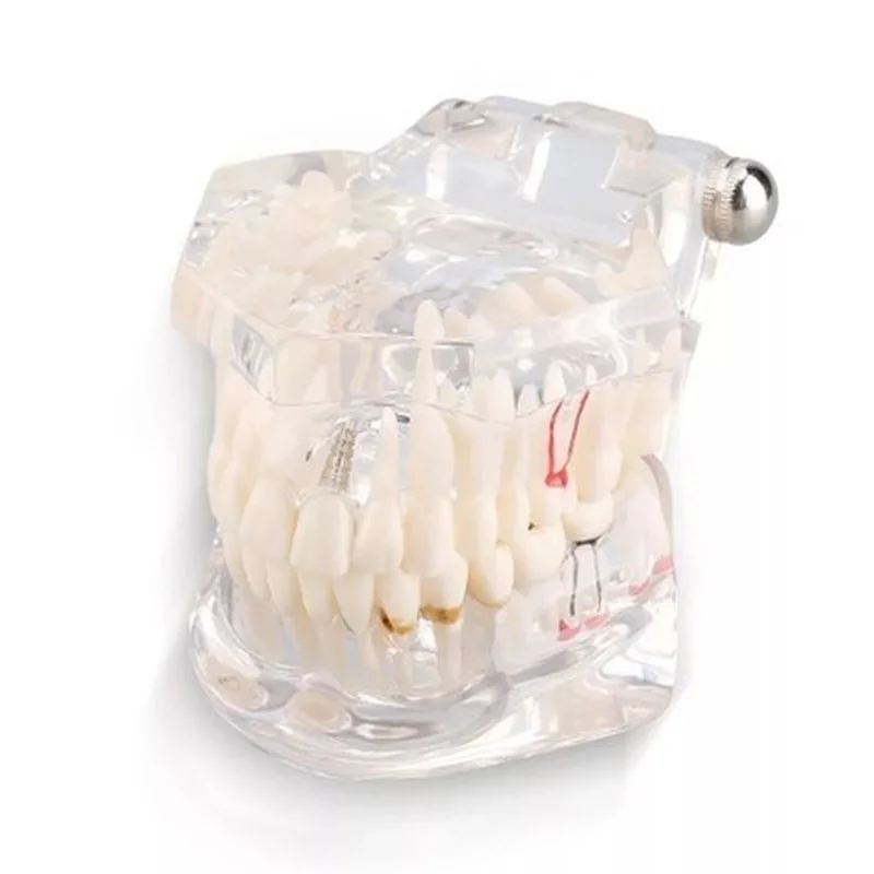 

1pcs Hot Sale Dental Implant Disease Teeth Model for Medical Teaching Oral Health Care Science Dental Disease Teaching Study