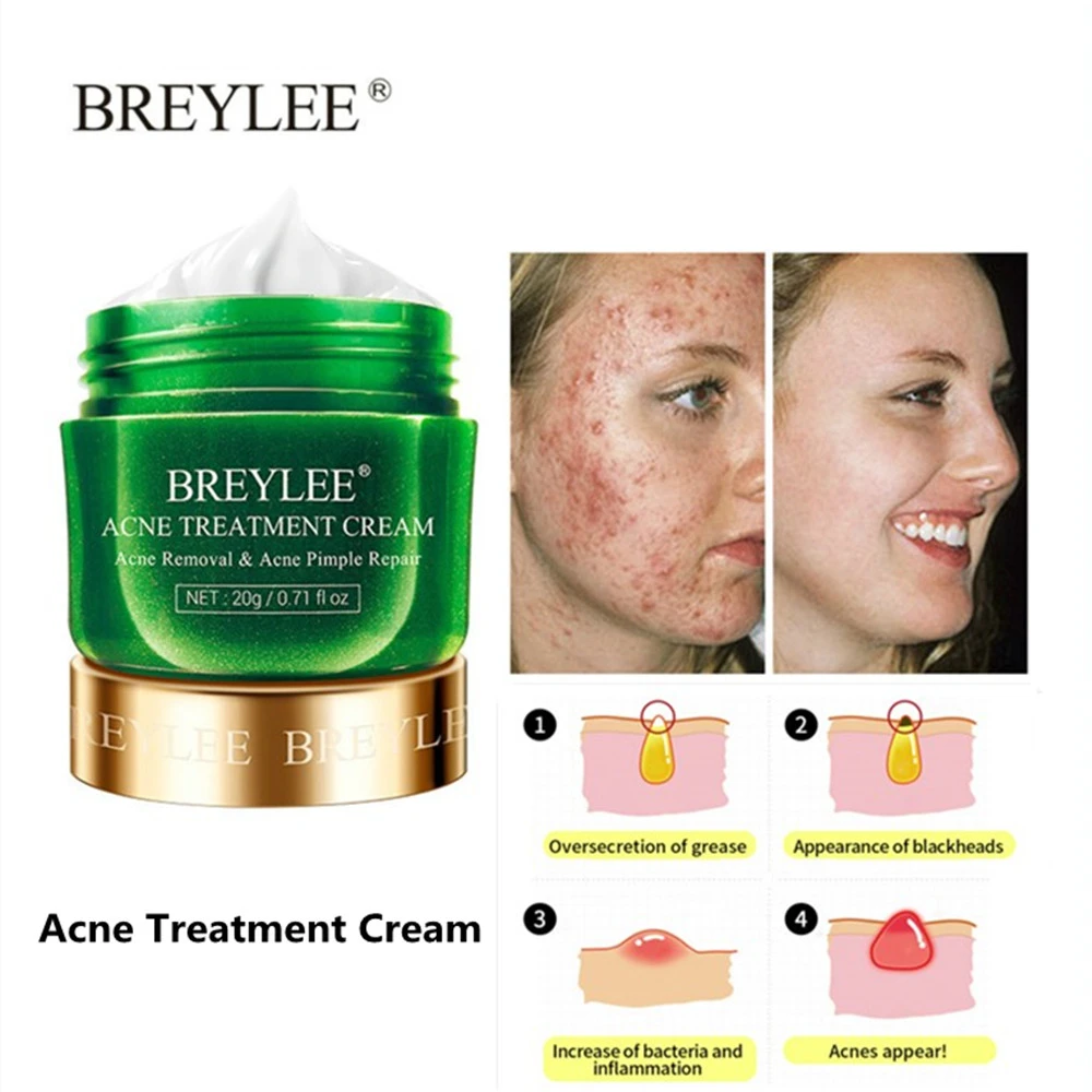 BREYLEE лечение акне шрам крем для лица против удаления прыщей пятна контроль