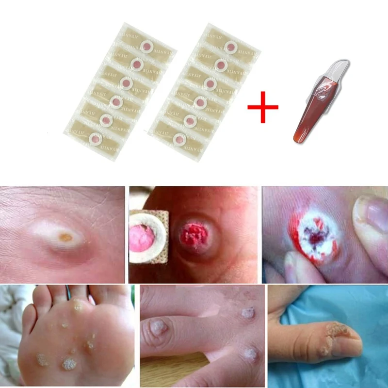 6Pcs /12pcs Wart Removal Patch Painlessly Remove Feet Callus Cutins Corn Remover Pads Soften Skin Cutin Care | Красота и здоровье