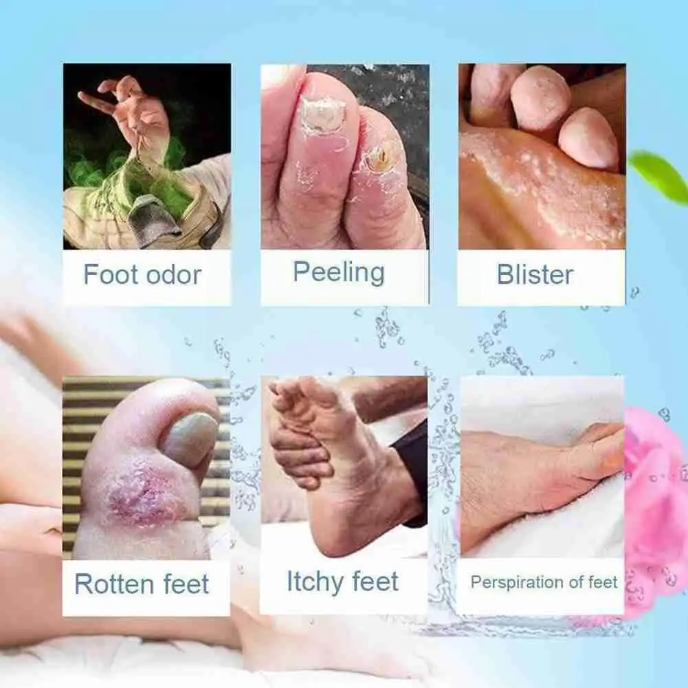 

30ml 20g Anti Fungal Infections Foot Cream Treatment Foot Athlete Beriberi Peeling Erosion Relief Itch Blisters Ointment Pa L3H6