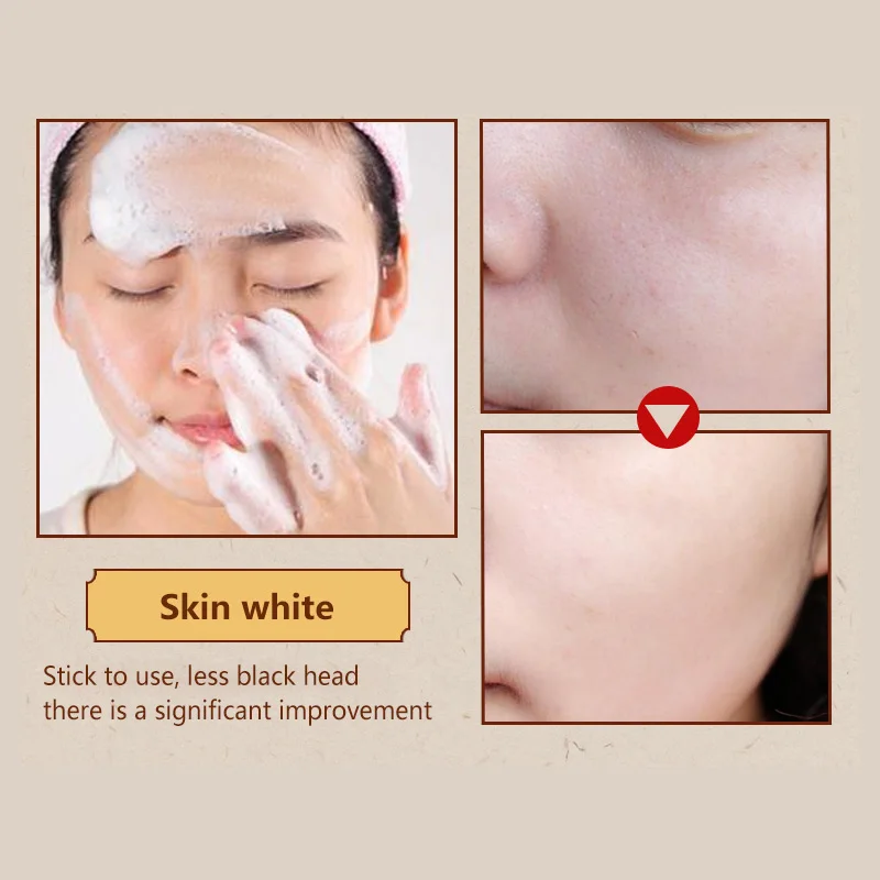 WXE 80 г Очиститель Удаление прыщей поры лечение акне увлажнение уход за лицом