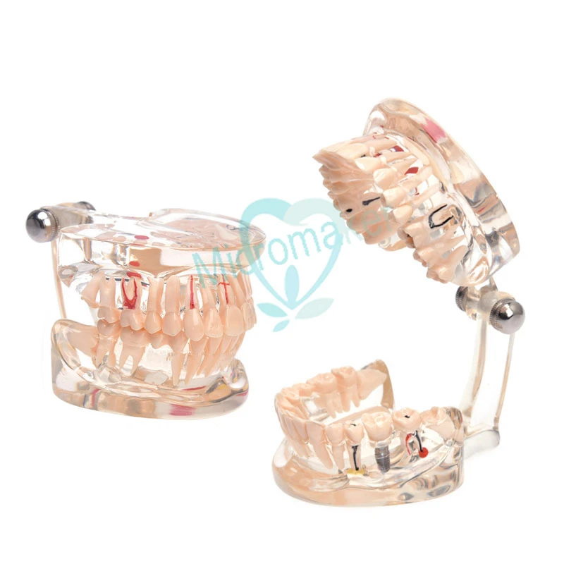 

1pcs Dental Implant Teaching Model With Restoration Bridge Tooth Dentist For Dental Disease Teaching Study