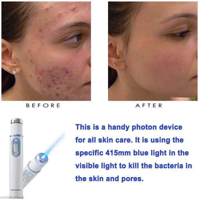 

2019 Portable Blue Light Remove Acne Pen Wrinkle Removal Skin Care Tool