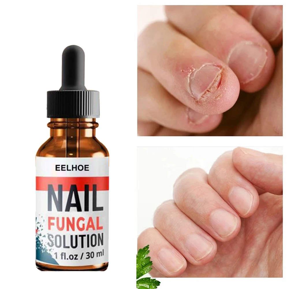 

Nail Fungal Treatment Feet Care Essence Anti Infection Paronychia Onychomycosis Feet Toenail Fungus Removal Liquid 30ml