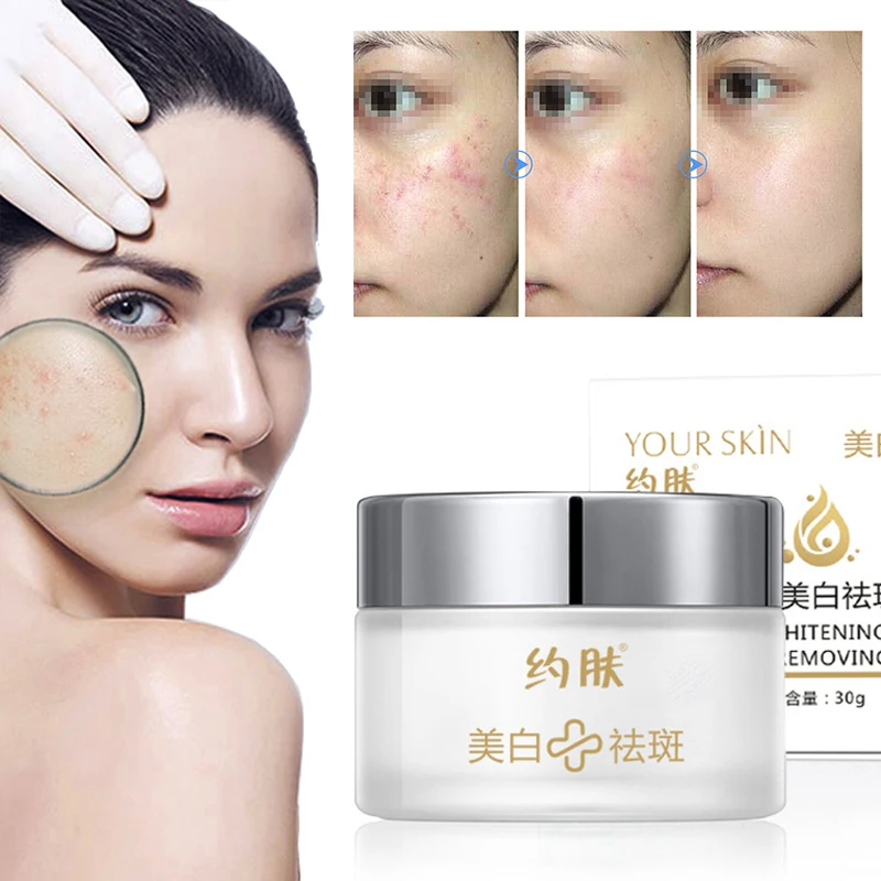 Мощный крем для отбеливания веснушек удаления мелазмы от черных точек прыщей