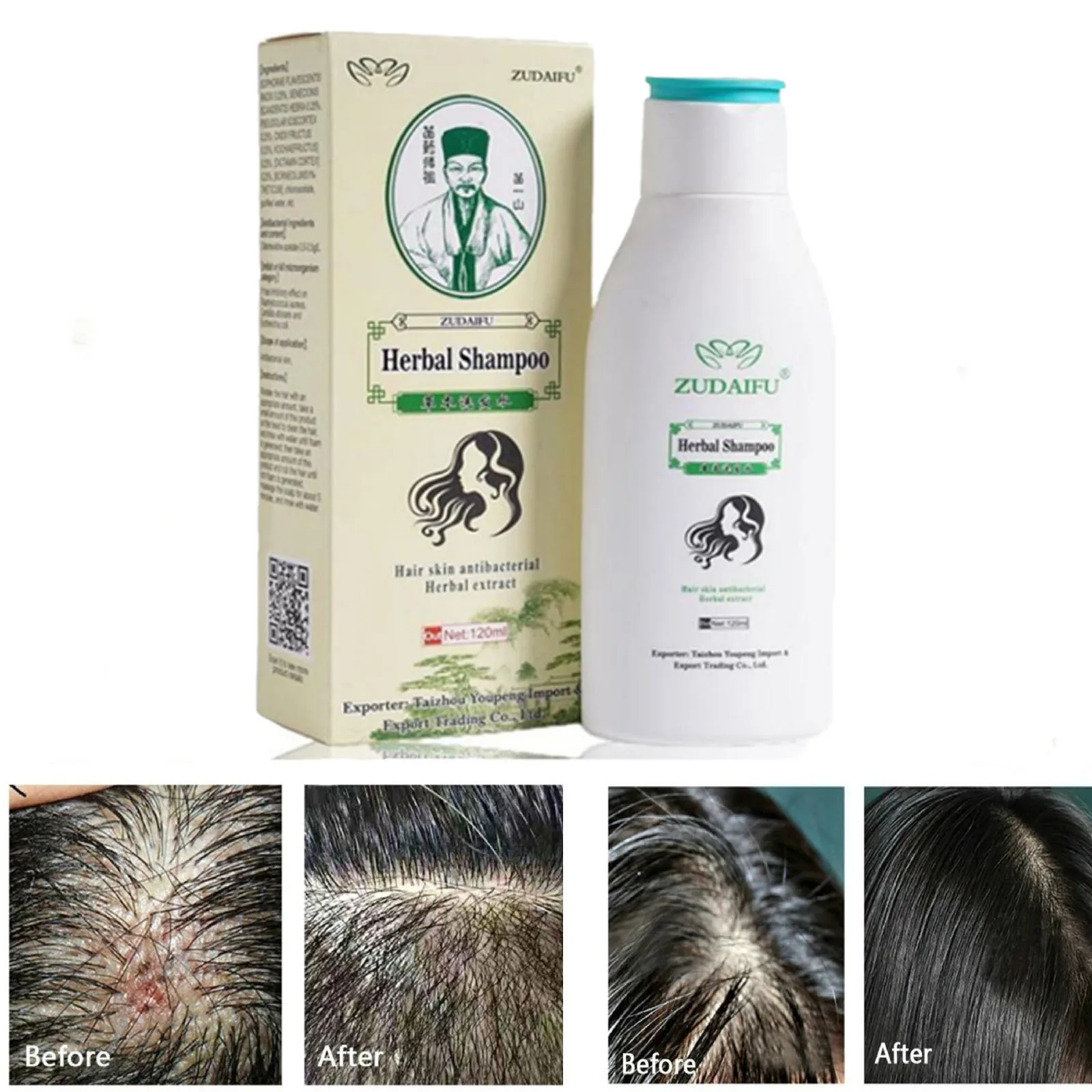 Средство для ухода за волосами Zudaifu псориаз себорореевое средство кожей дерматит