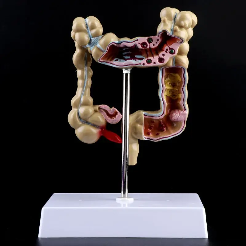 

Human Colorectal Lesion Model Pathological Anatomy Colon Diseases Intestine Medical Teaching Learning Tool 19QA