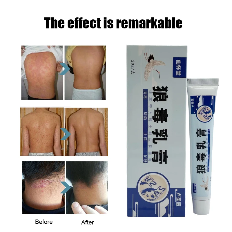 Лечение псориаза крем Антибактериальный уход за кожей антиприурический