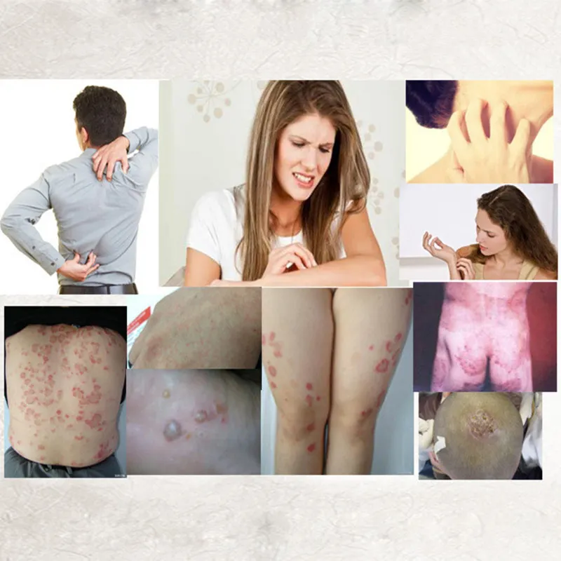 

2021 New High Quality Skin Care Cream Chinese Medicine Plaster Psoriasis Eczema Ointment Body Dermatitis Balm