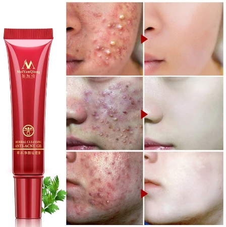 Отбеливающий крем для лица против прыщей и комедонов 15 г| |