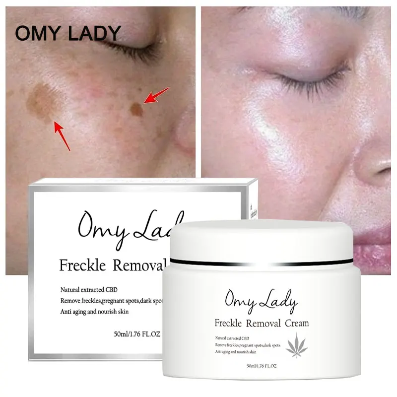 OMY LADY для отбеливания веснушек крем удаления пятен мощное средство лица против