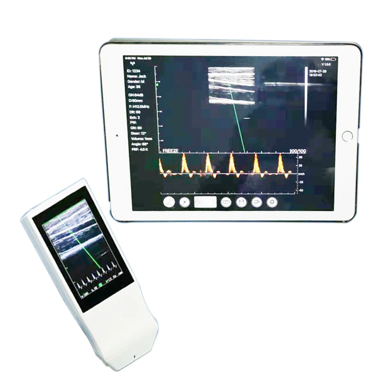 

Newest Mindray pocket ultrasound transducer probe Color wireless ultrasound WIFI