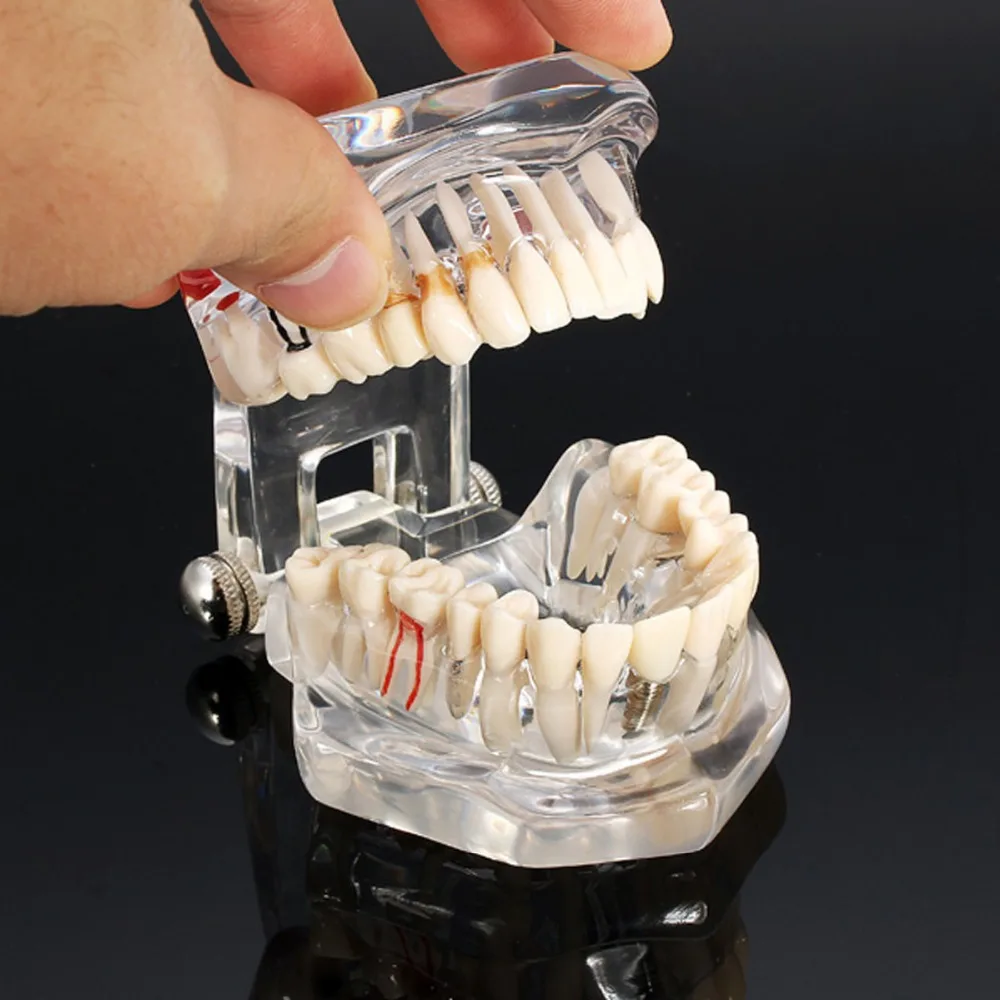 

Стоматологическая Исследование обучения для ослепительно белых зубов, модель кариеса зуб средства для ухода за полостью рта образования С...