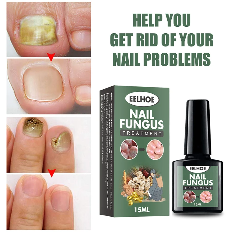 

Nail Fungal Cure Nail Fungus Removal Liquid Nutritious Anti Paronychia Repair