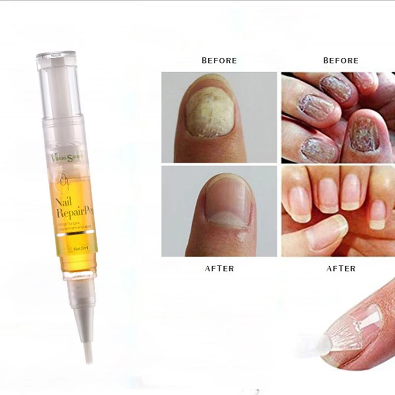 

5ML Treatment Pen Sexy Nail Care Repair Growth Oils Enhance Damaged Cuticles Nail Cuticle Care Moisturizing Nail Repair Oil Foot