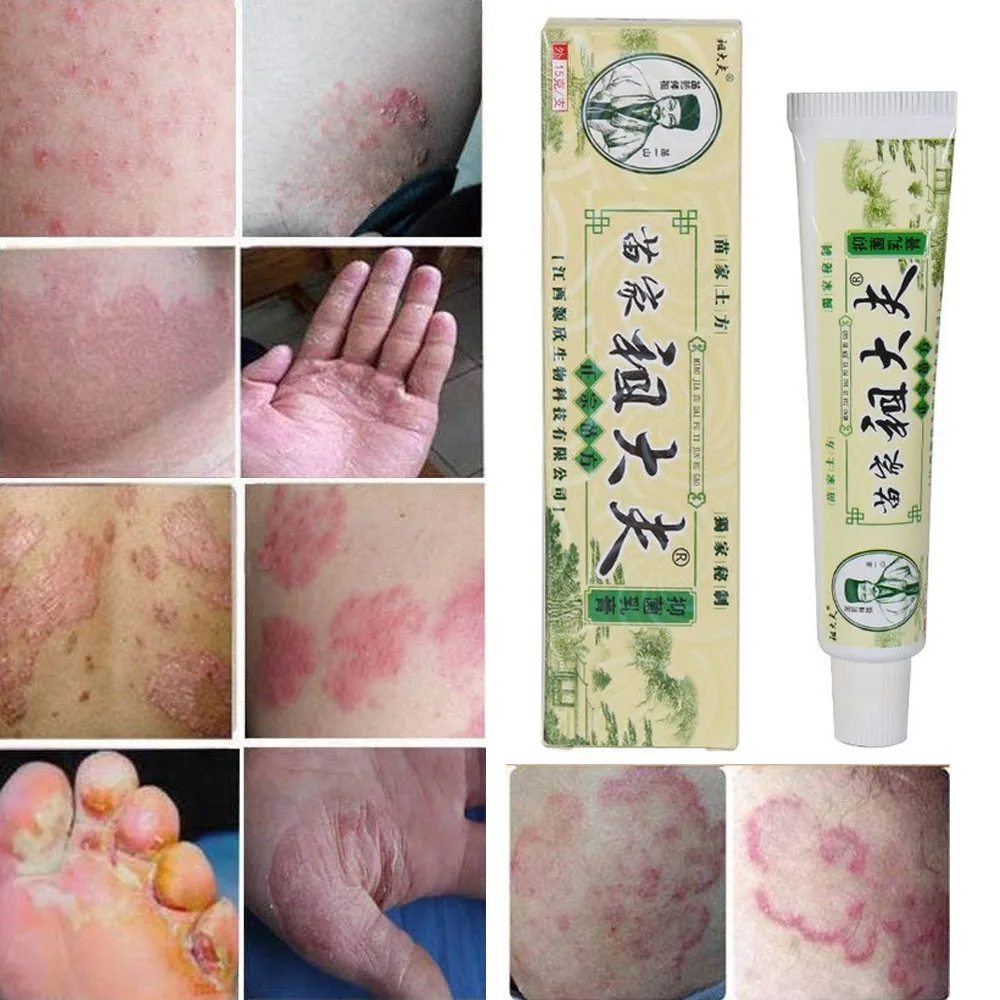 

1pc zudaifu Psoriasis Cream Psoriasis Ointment Dermatitis Eczematoid Eczema Ointment Skin Treatment Cream Eczema Ointment Skin