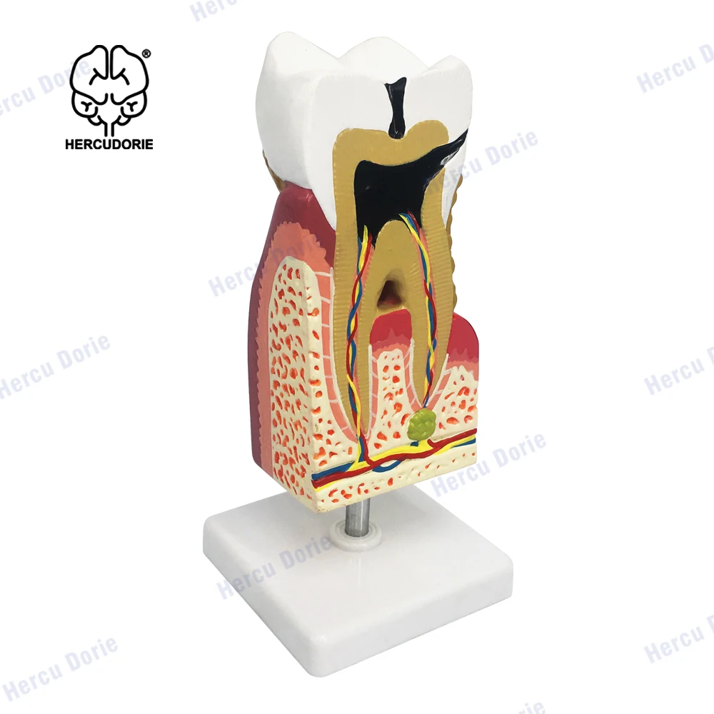 

Dental pathology model, teaching model, dental model